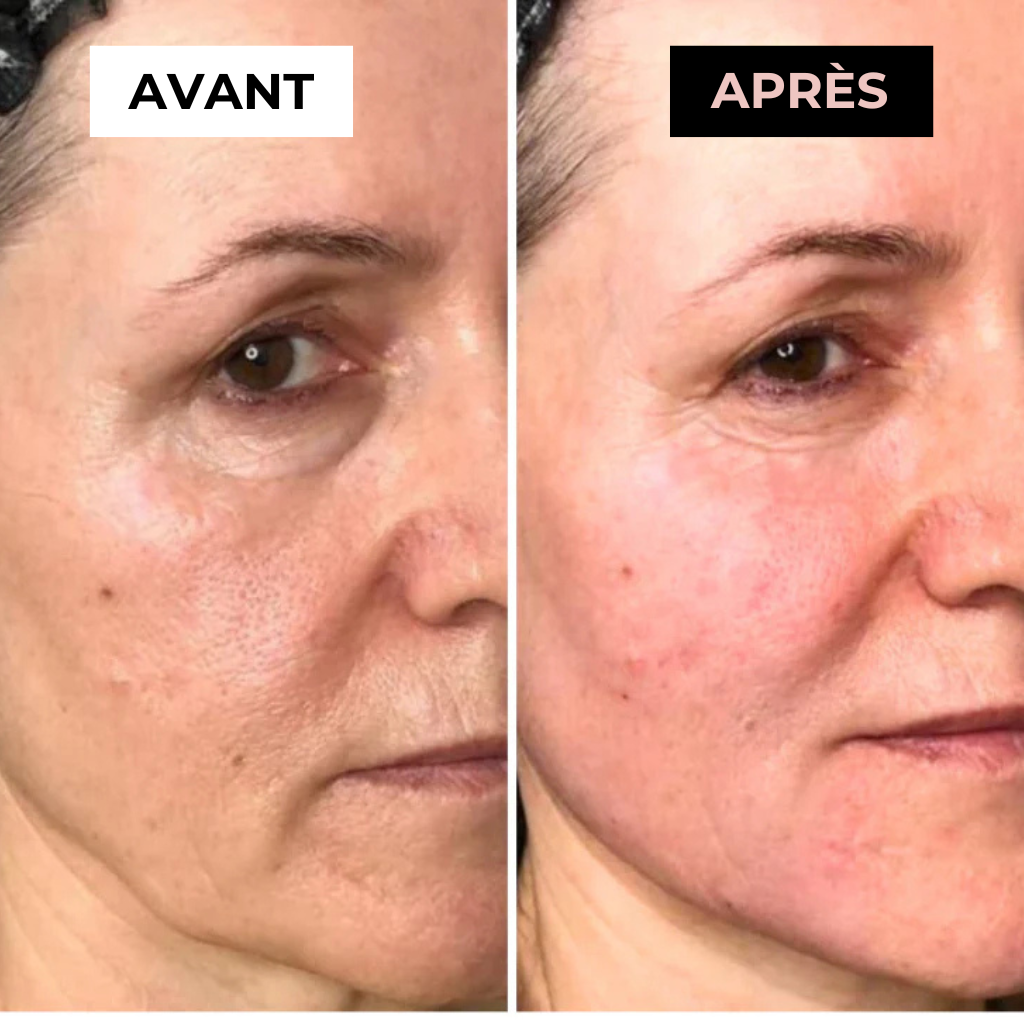 Masseur Noreska | Anti-acné et Anti-rides