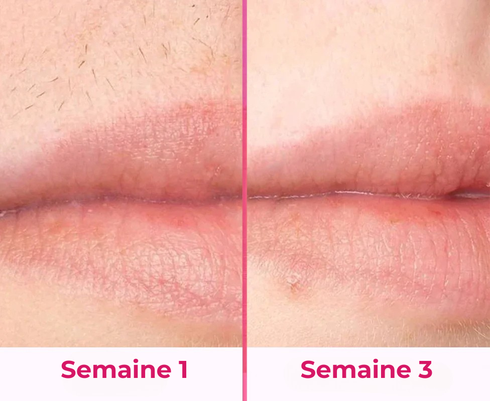 Koliza - Épilateur à Lumière Pulsée | Pack