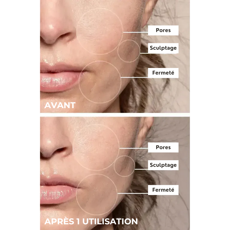 Sculpteur de Peau Koliza| Anti-acné et Anti-rides