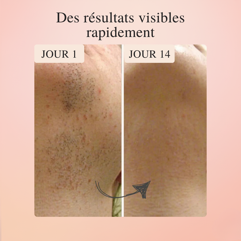 LumiSkin™ – L'épilateur #1 à lumière pulsée à domicile 2.0