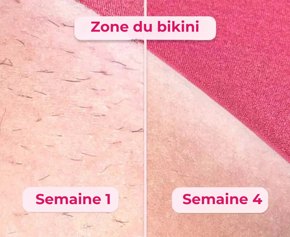 Koliza - Épilateur à Lumière Pulsée | Pack