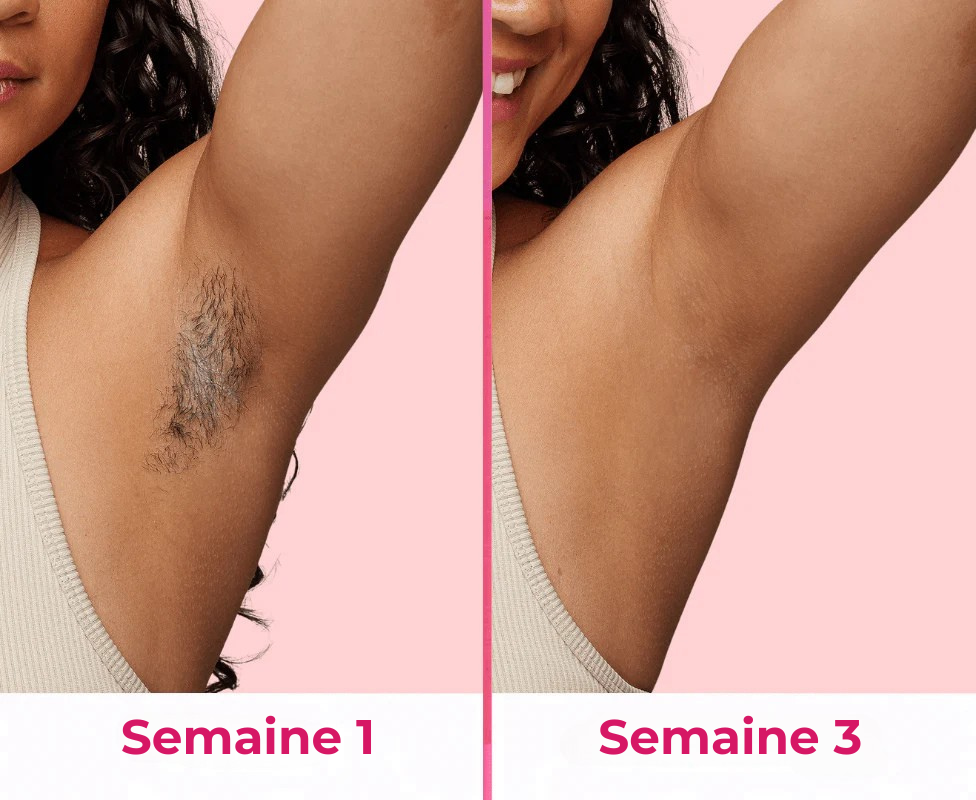 Koliza - Épilateur à Lumière Pulsée | Pack