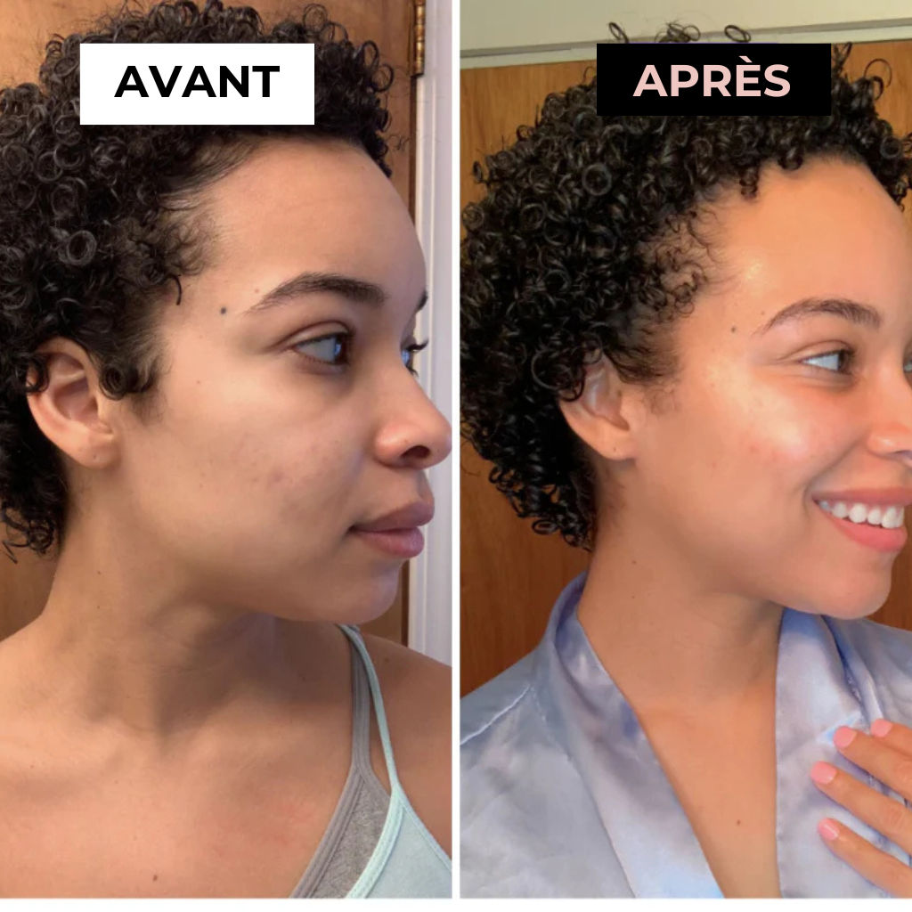 Masseur Noreska | Anti-acné et Anti-rides