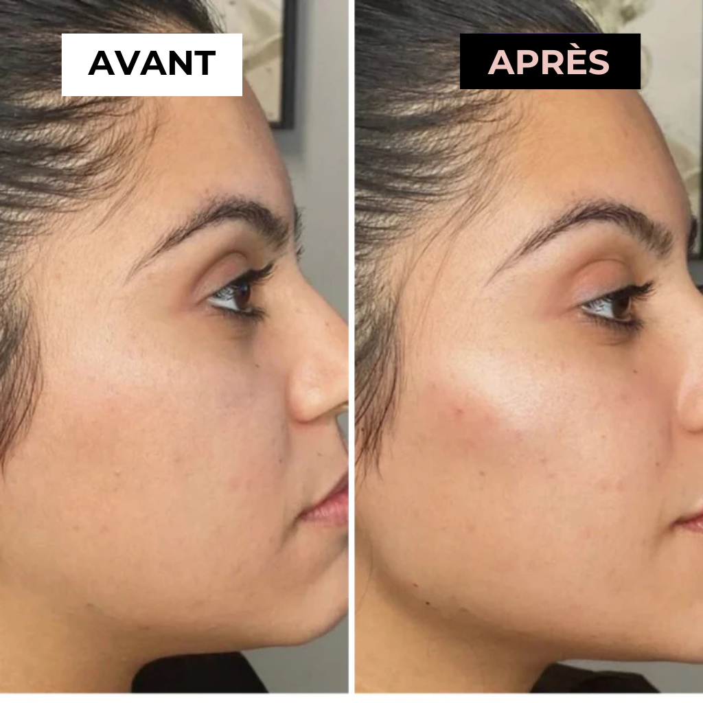 Masseur Noreska | Anti-acné et Anti-rides