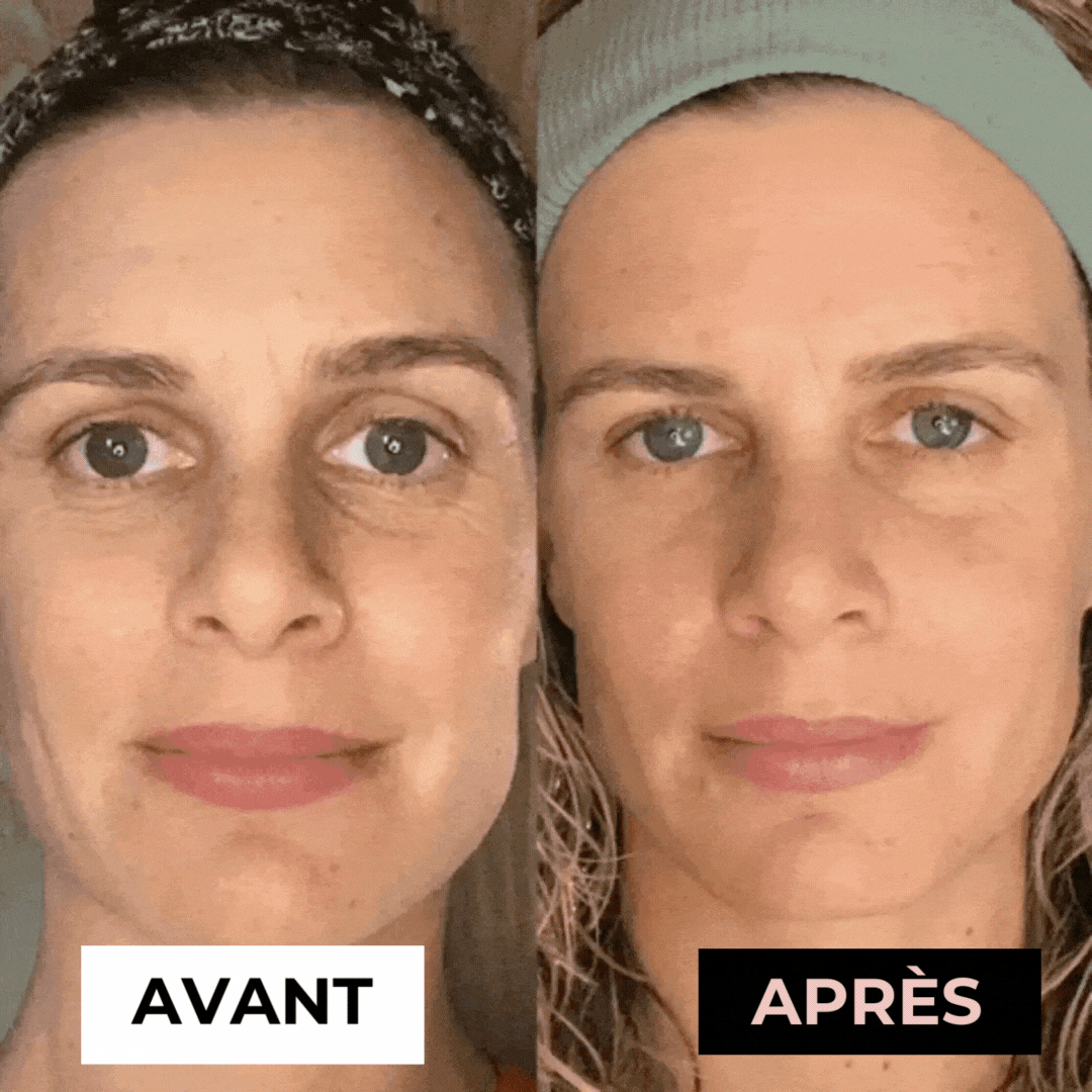 Masseur Noreska | Anti-acné et Anti-rides